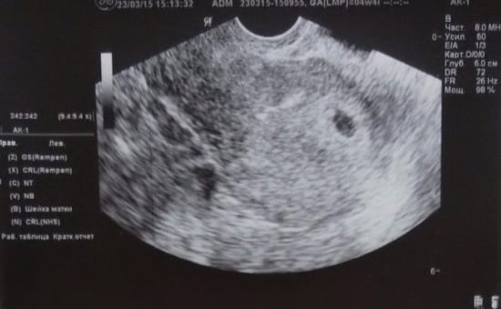 4 ultrasound weeks at 4 Week