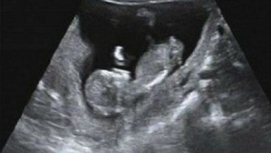 11 weeks pregnant ultrasound #3