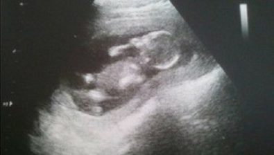 15 weeks pregnant ultrasound #3