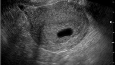 ultrasound at 5 weeks pregnant