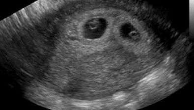 ultrasound at 5 weeks pregnant