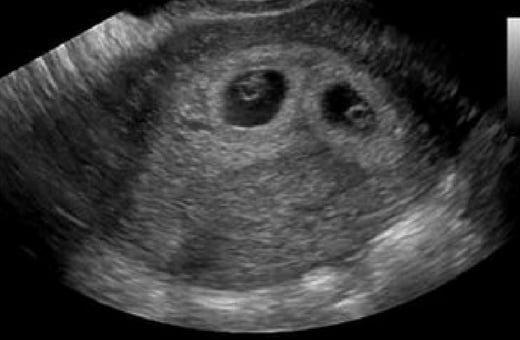 5 week sonogram