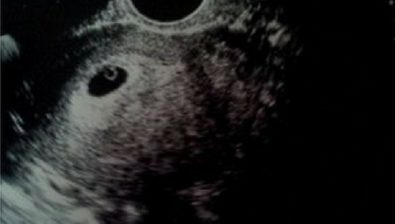ultrasound at 5 weeks pregnant