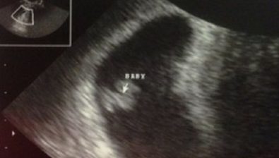 ultrasound at 5 weeks pregnant