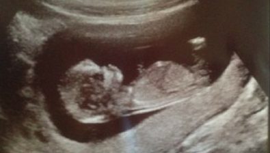 10 weeks pregnant ultrasound #1