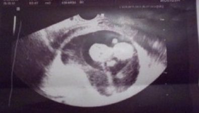 10 weeks pregnant ultrasound #2