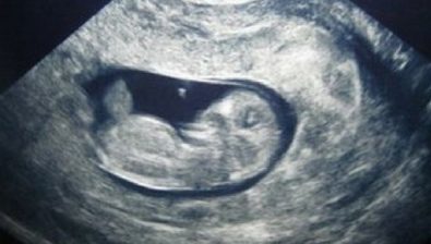 10 weeks pregnant ultrasound #3