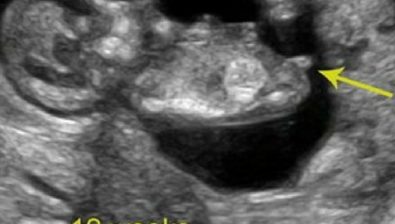 12 weeks pregnant ultrasound #2
