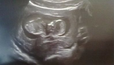 12 weeks pregnant ultrasound #3