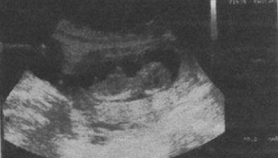 13 weeks pregnant ultrasound #1