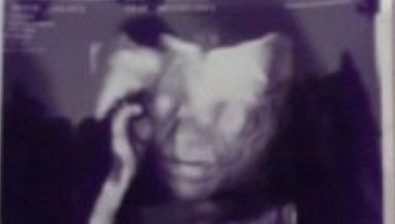 13 weeks pregnant ultrasound #2