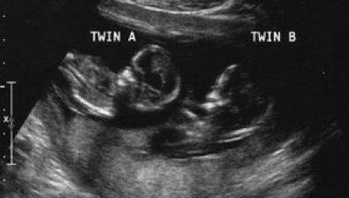 13 weeks pregnant ultrasound #4