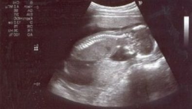 17 weeks pregnant ultrasound #1