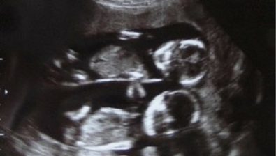 17 weeks pregnant ultrasound #4