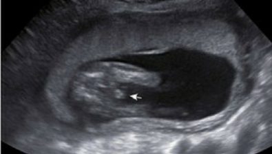 20 weeks pregnant ultrasound #1