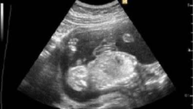 20 weeks pregnant ultrasound #2