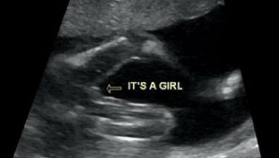 20 weeks pregnant ultrasound #3