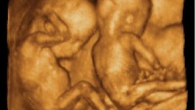 20 weeks pregnant ultrasound #4