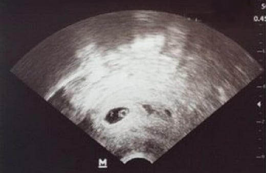 6 акушерская неделя беременности узи. 6 Акушерских недель беременности на УЗИ. УЗИ снимок на 6 акушерской неделе. УЗИ на 5-6 неделе беременности акушерская. УЗИ 6 недель беременности акушерских недель.
