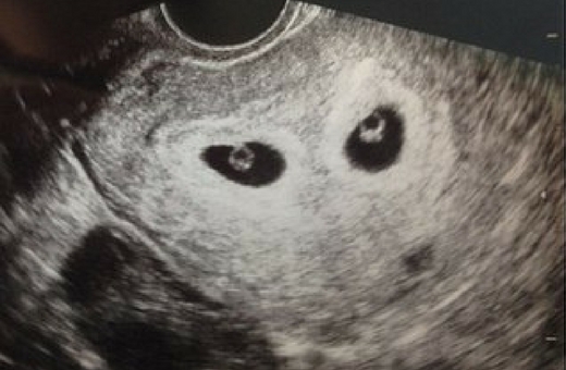 To expect at 6 week ultrasound