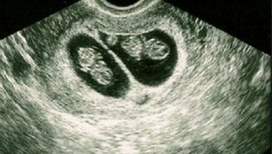 7 weeks pregnant ultrasound #2