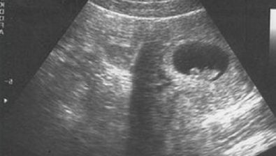 7 weeks pregnant ultrasound #3