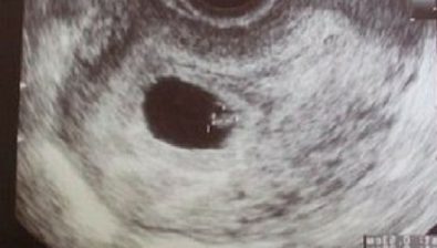 7 weeks pregnant ultrasound #1