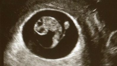 8 weeks pregnant ultrasound #1