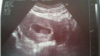8 weeks pregnant ultrasound #2