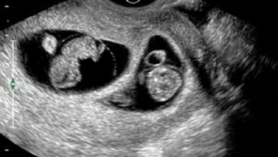 8 weeks pregnant ultrasound #3