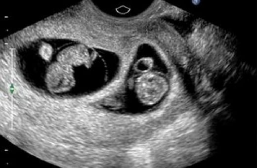 Pregnant ultrasound weeks 8 32 weeks