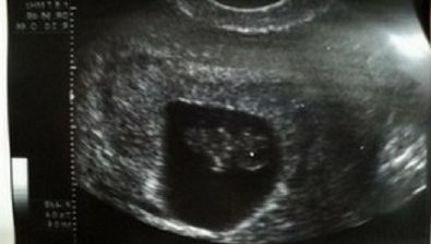 8 weeks pregnant ultrasound #4