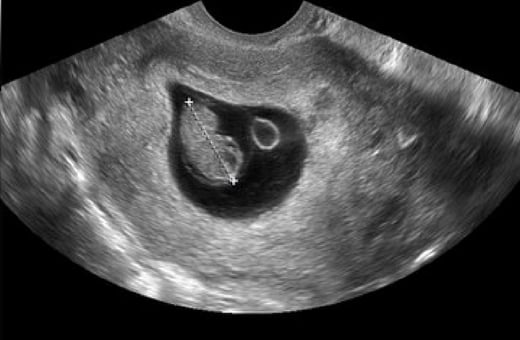 At week what 9 ultrasound expect to Transvaginal Ultrasound: