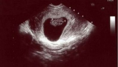 9 weeks pregnant ultrasound #3